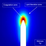 koncowka lasera do lipolizy 150x150 Zaawansowane: Laserowa lipoliza tłuszczu SlimLipo – Sposób dostarczania energii: fala ciągła a impulsy